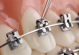 Self-Ligating Braces: Key Advantages Over Traditional Braces