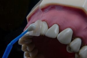 Braces vs Veneers: Honest Breakdown of Pros, Cons, and Costs