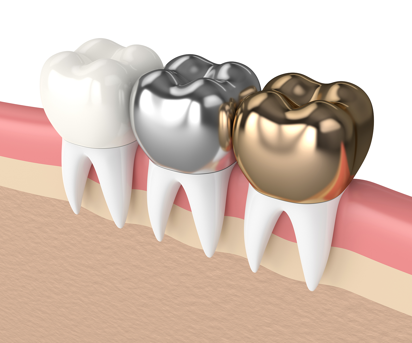 Porcelain vs zirconia crown comparison for strong and natural smiles