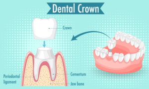 Dentist in McAlester Oklahoma explaining crown options to patient