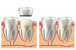 Orthodontist McAlester OK discussing porcelain vs zirconia crown benefits