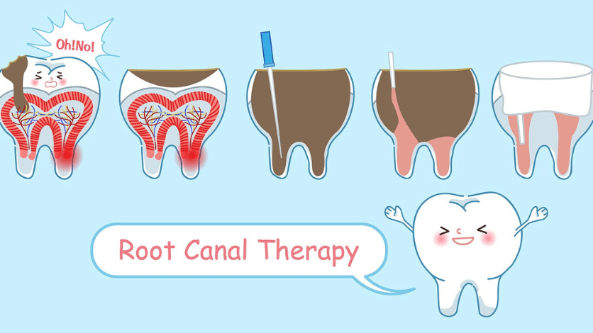An illustration of how root canal treatment works