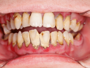 Professional tartar removal