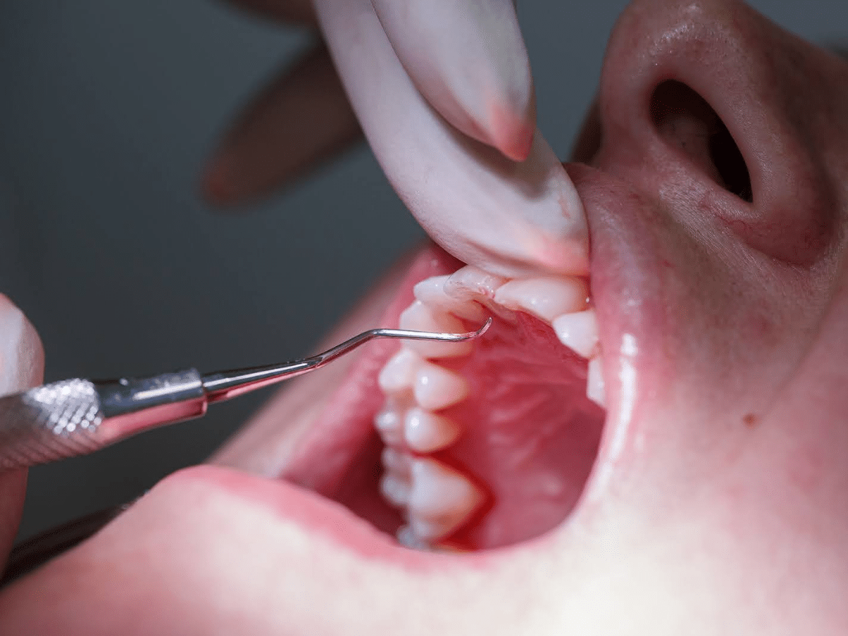 Remove tartar from teeth through professional dental cleaning