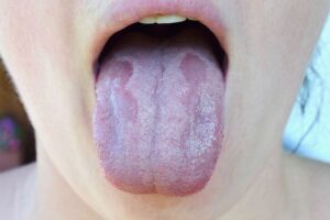 What Are The Reasons For A White Tongue